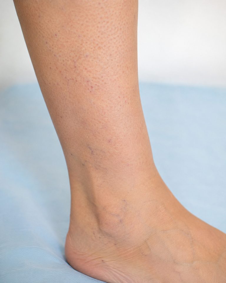 realistic medical photo of lower leg skin showing subtle vascular spots